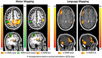 Pre-surgical Brain Mapping: To Rest or Not to Rest?